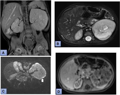 Case Report: Autosomal dominant polycystic kidney disease and Wilms’ tumor in infancy and childhood